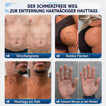 🏆𝗖𝘂𝗿𝗲𝗩𝗶𝘃𝗼® 𝟕-Tage Hautwärzchen & Flecken-Entfernungscreme (Schmerzfreie Formel – Keine Narben)🤗