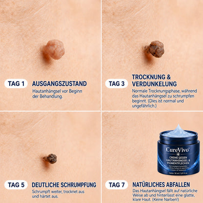 🏆𝗖𝘂𝗿𝗲𝗩𝗶𝘃𝗼® 𝟕-Tage Hautwärzchen & Flecken-Entfernungscreme (Schmerzfreie Formel – Keine Narben)🤗