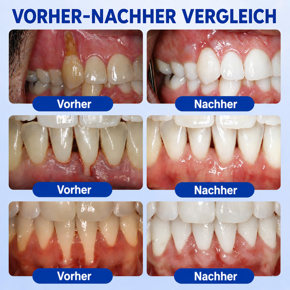 🇩🇪👨‍⚕️🦷🛡️ HEATWOLF® GumRevive – Parodontales Regenerationsgel🐟