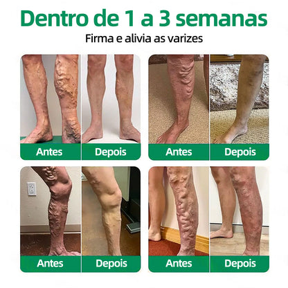 🇵🇹👨‍⚕️✅Healrize® VeinTarget Microneedle Patch⚡Alívio Instantâneo, Resultados Duradouros🤠