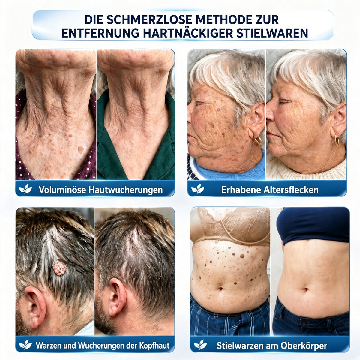 🏆𝗖𝘂𝗿𝗲𝗩𝗶𝘃𝗼® 𝟕-Tage Hautwärzchen & Flecken-Entfernungscreme (Schmerzfreie Formel – Keine Narben)🤗